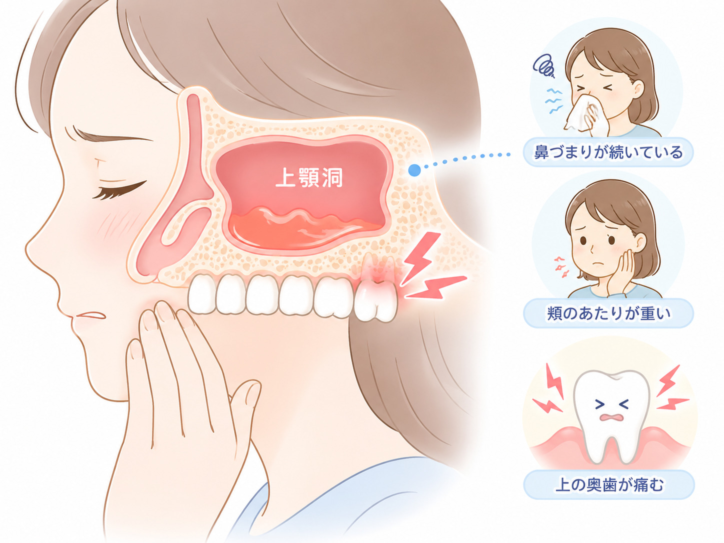 上顎洞と上の奥歯の位置関係を示したイラスト