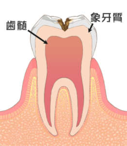 象牙質まで進行した虫歯のイラスト