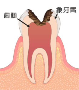 神経まで進行した虫歯のイラスト