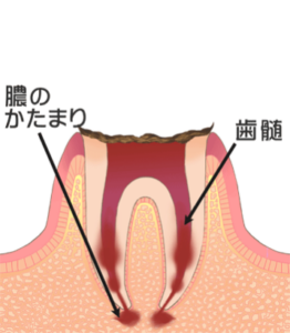 歯の大部分が失われた重度の虫歯のイラスト