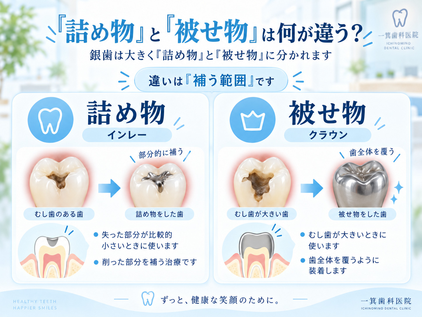 詰め物のインレーと被せ物のクラウンの違いを補う範囲で比較した図