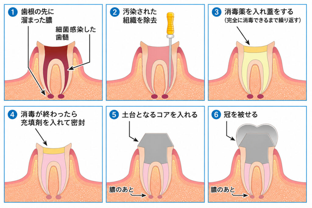 根管治療の流れを6つのステップで示したイラスト