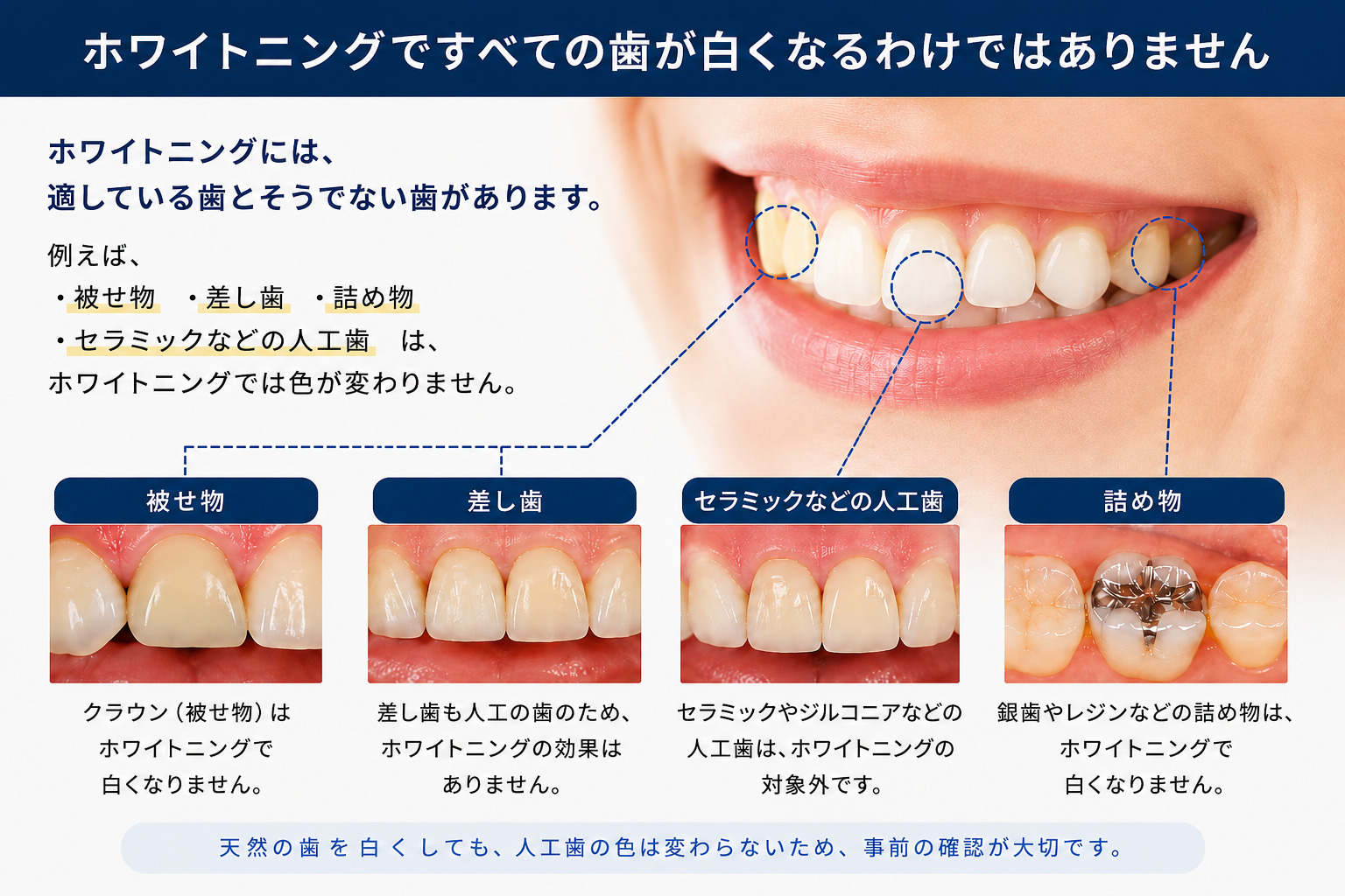 ホワイトニングで色が変わらない被せ物・差し歯・セラミック・詰め物の解説画像